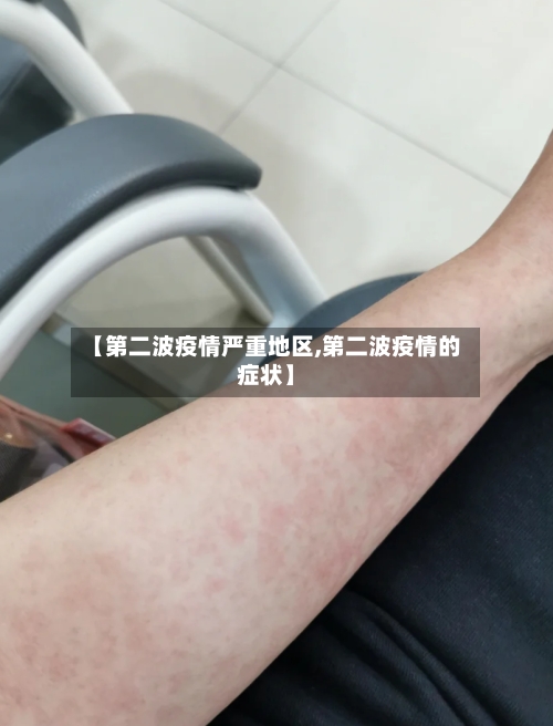 【第二波疫情严重地区,第二波疫情的症状】-第2张图片