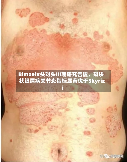 Bimzelx头对头III期研究告捷，斑块状银屑病关节炎指标显著优于Skyrizi-第2张图片