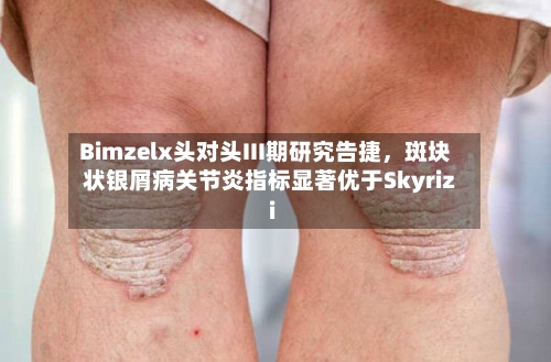 Bimzelx头对头III期研究告捷，斑块状银屑病关节炎指标显著优于Skyrizi-第1张图片